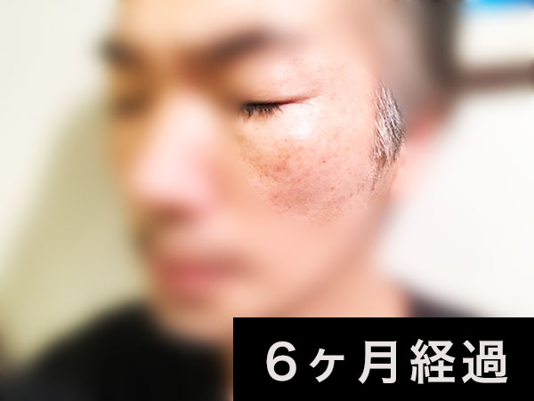 40代男性メンズ シミ ケア 【クワトロボタニコ】1ヶ月,2ヶ月,3ヶ月,4ヶ月,5ヶ月,6ヶ月使用シミ消しレビュー